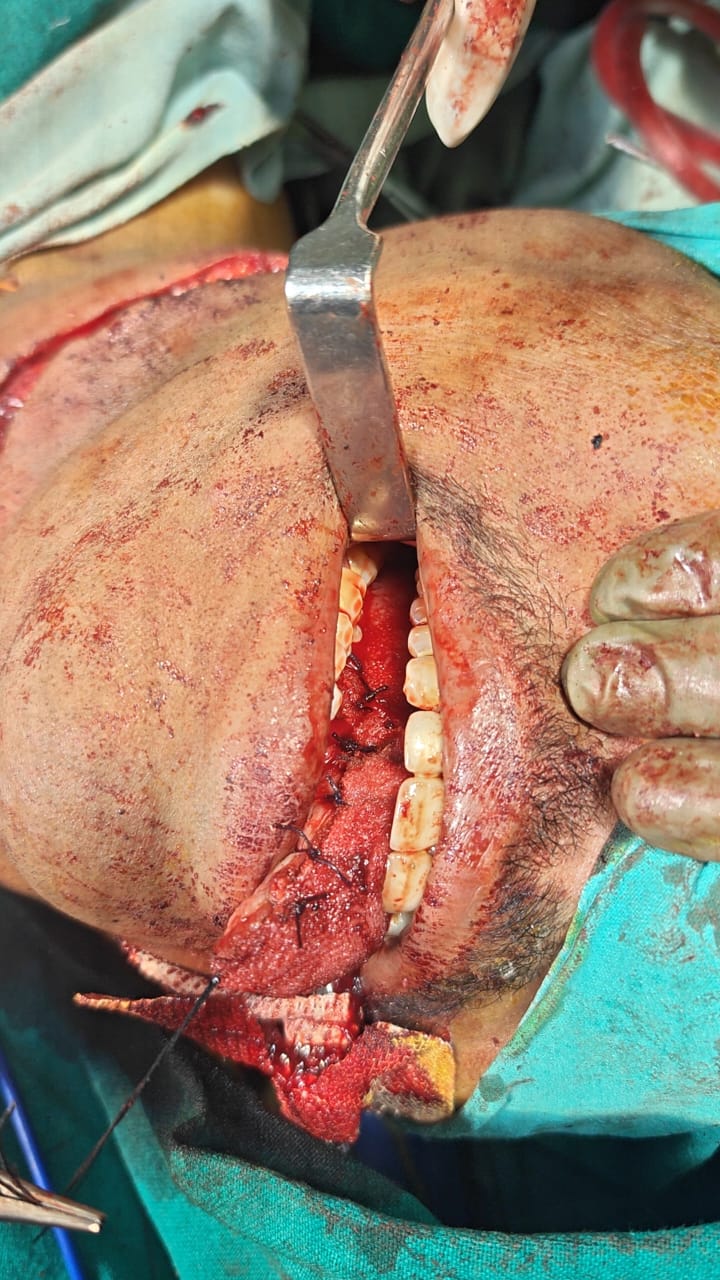 CA Tongue with neck node dissection image 2