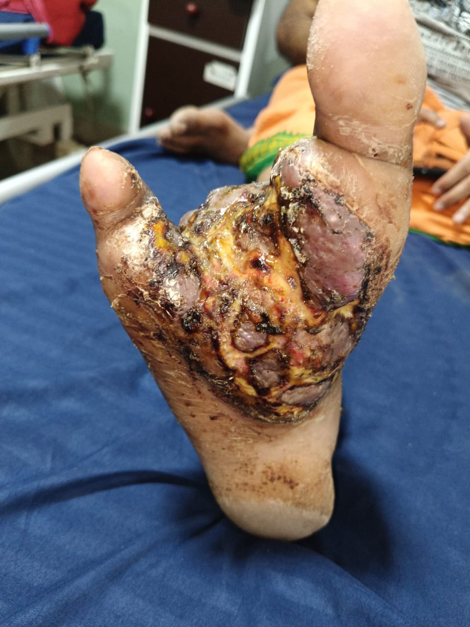 Diabetic foot with plastic surgery repair image 2