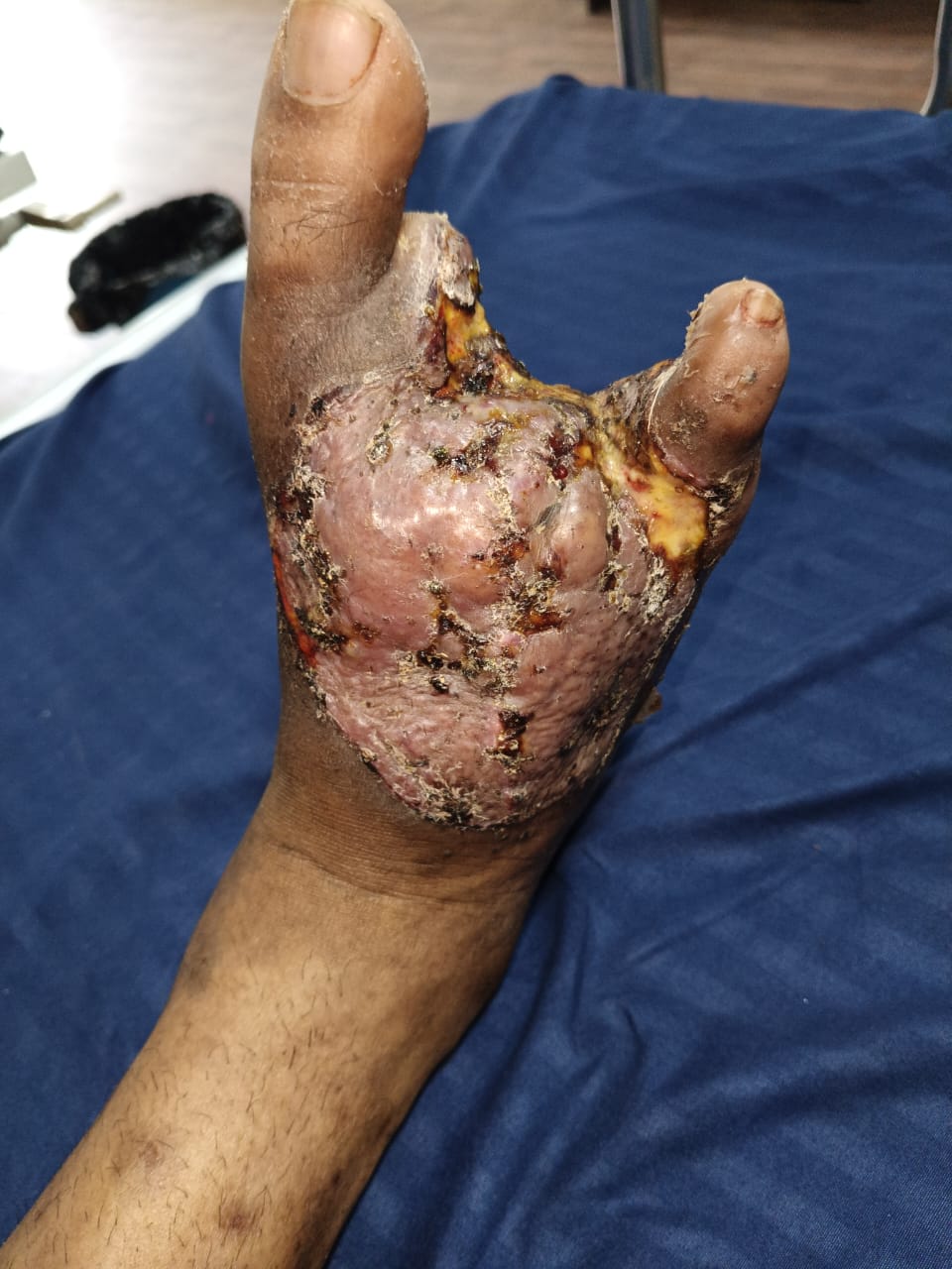 Diabetic foot with plastic surgery repair image 3