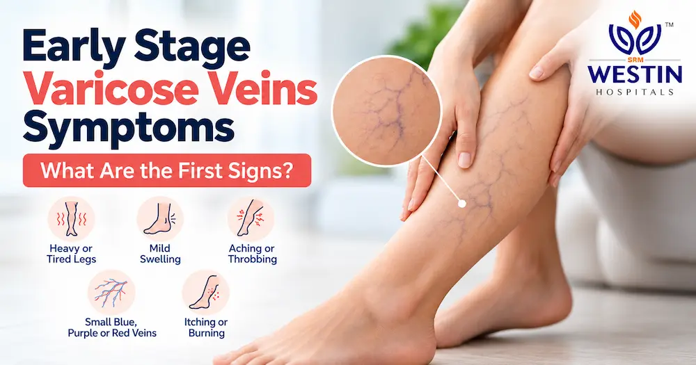 Early Stage Varicose Veins Symptoms and First Signs